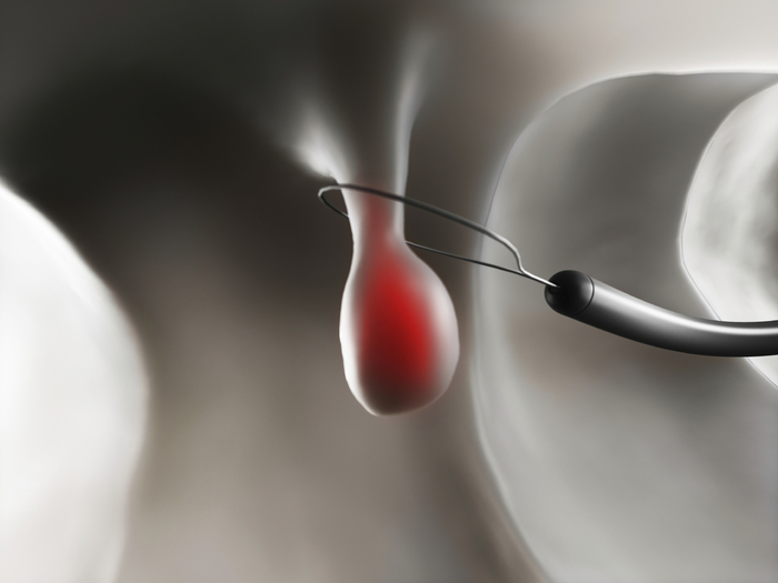 Sigmoidoscopy procedure